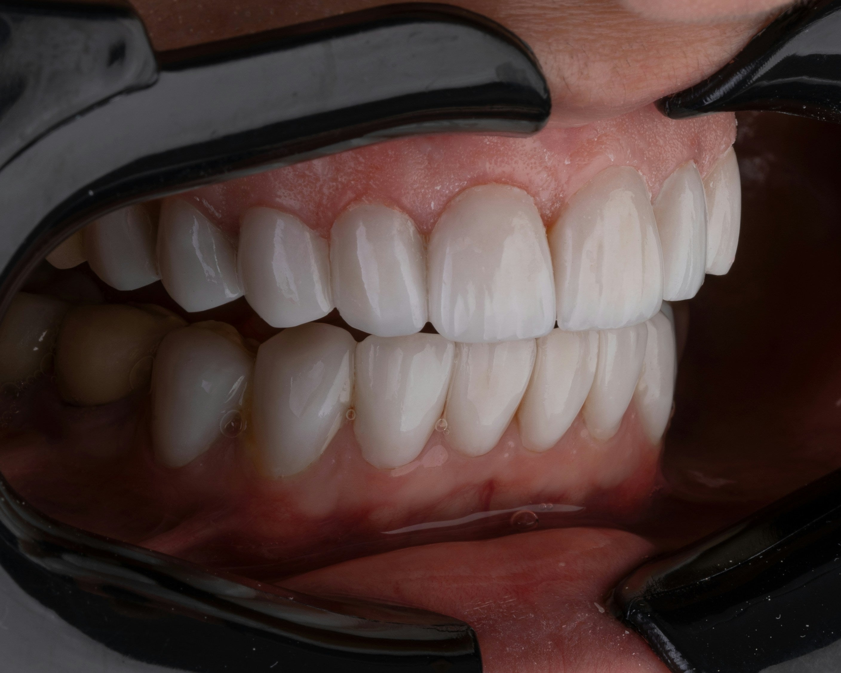 Teeth Whitening Session