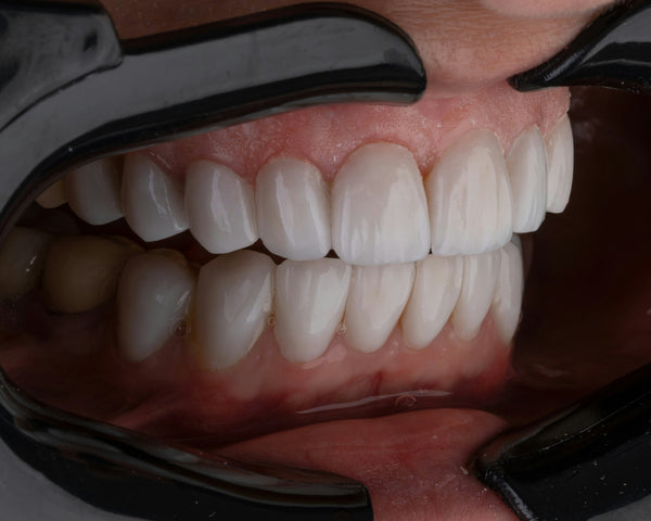 Teeth Whitening Session